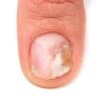 nail fungus treatment otc